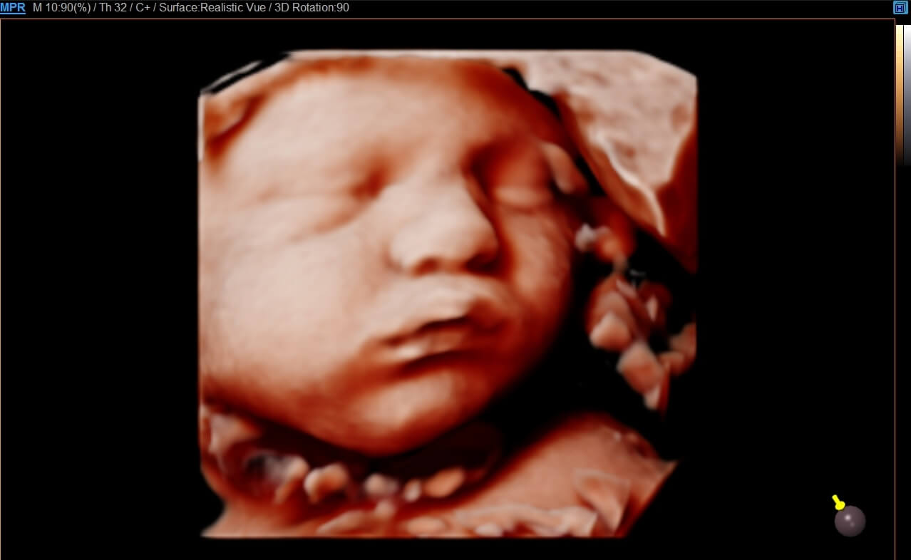 Rostro fetal con RealisticVue ™