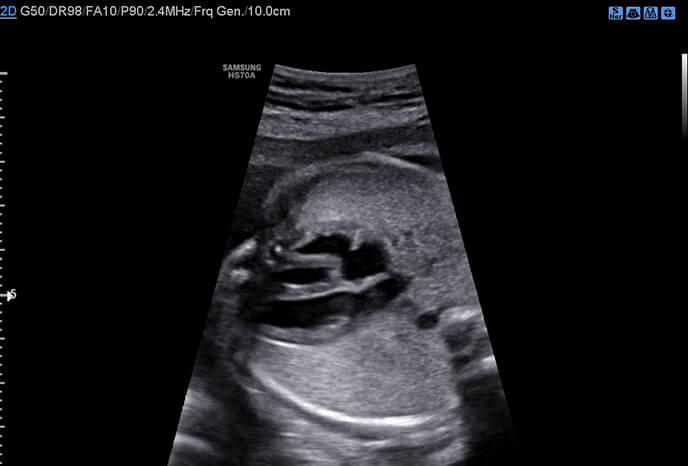 Corazón fetal en vista de cuatro cámaras