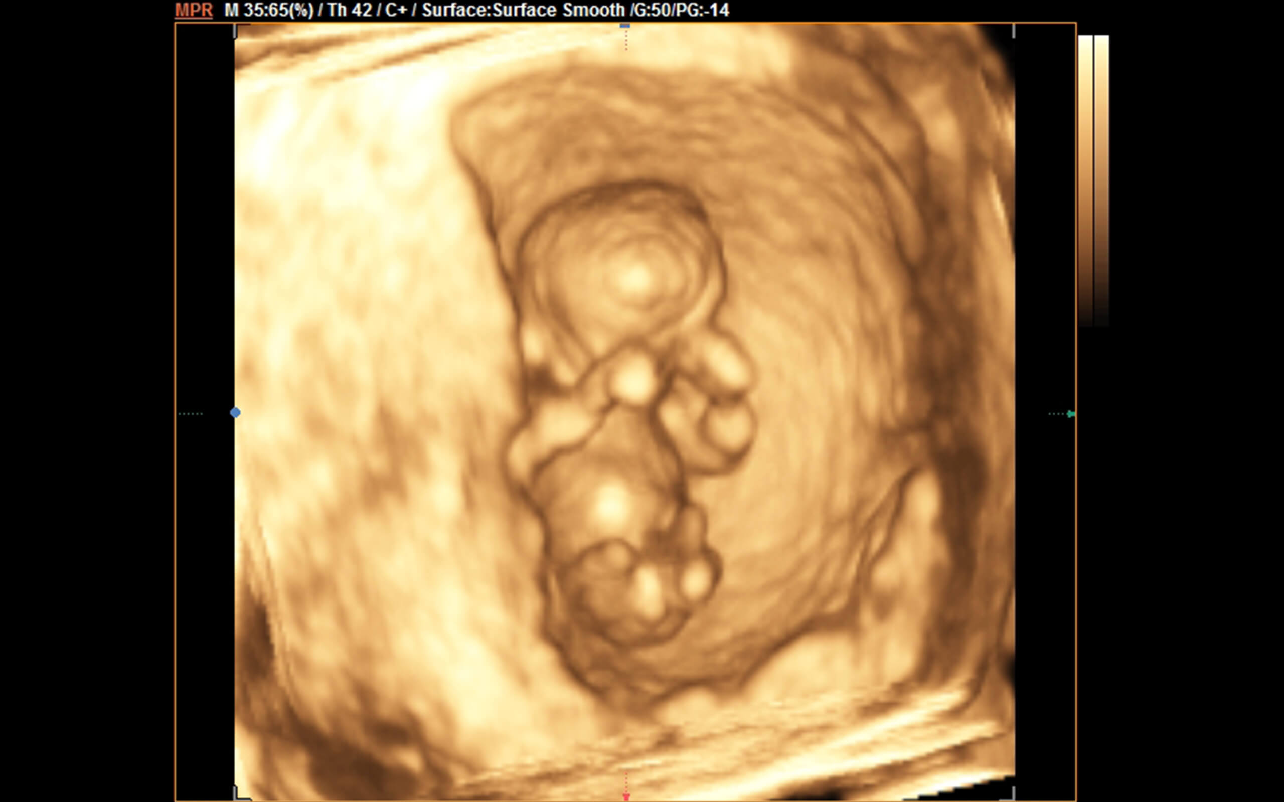 1er trimestre fetal 3D